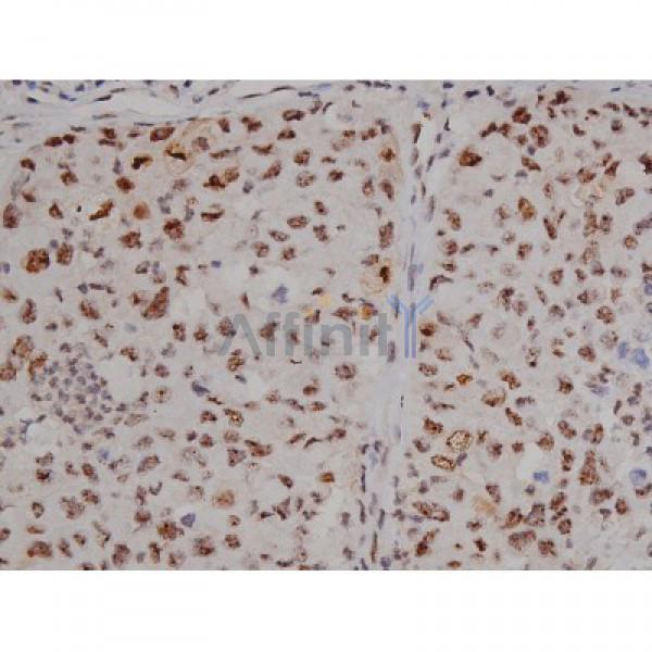 Phospho-Tau (Ser396) Antibody - AF3148 at 1/200 staining Human lung cancer tissue sections by IHC-P.